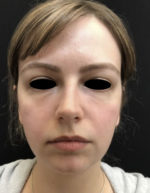 Around The Eye Fillers