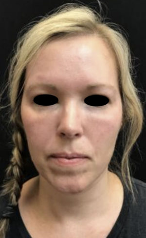 Around The Eye Fillers