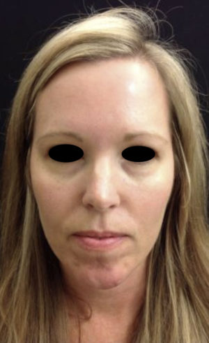 Around The Eye Fillers