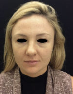 Around The Eye Fillers