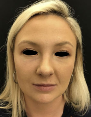 Around The Eye Fillers