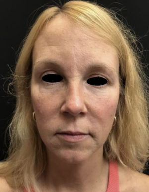 Around The Eye Fillers