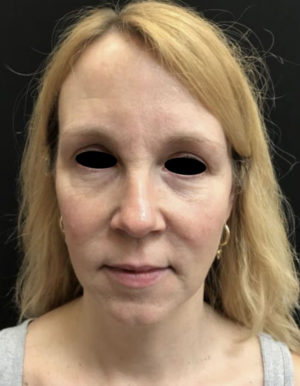 Around The Eye Fillers