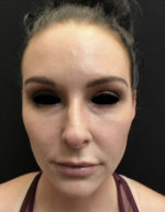 Around The Eye Fillers