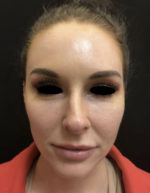 Around The Eye Fillers