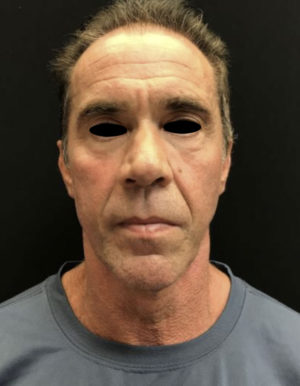 Around The Eye Fillers