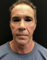 Around The Eye Fillers