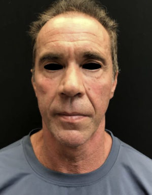 Around The Eye Fillers