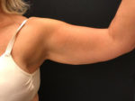 BodyTite