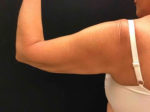 BodyTite