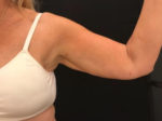 BodyTite