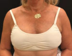 BodyTite