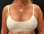 BodyTite