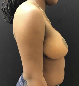 Breast Reduction