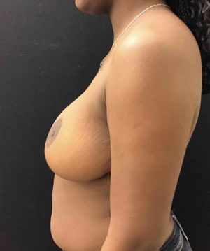 Breast Reduction