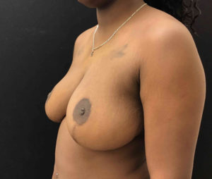 Breast Reduction