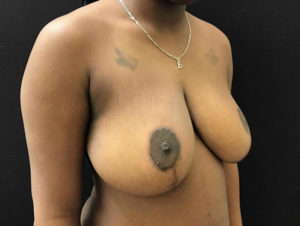 Breast Reduction