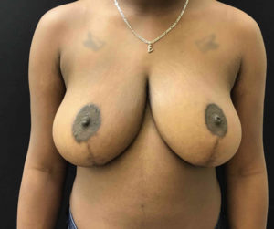 Breast Reduction