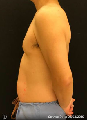 EMSCULPT