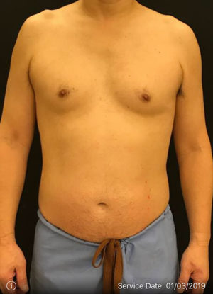EMSCULPT