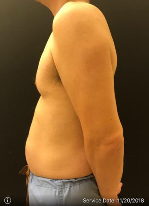 EMSCULPT