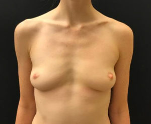 Breast Augmentation