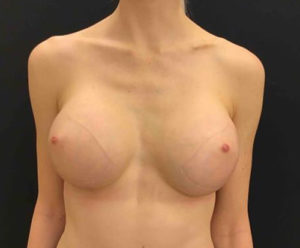 Breast Augmentation