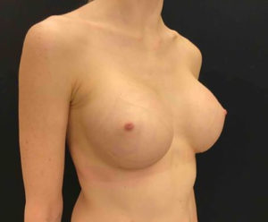 Breast Augmentation