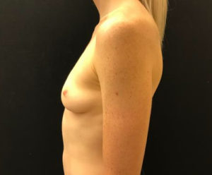 Breast Augmentation