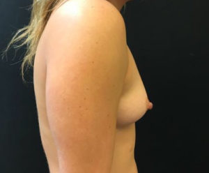 Breast Augmentation