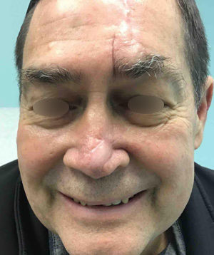 Nasal Reconstruction