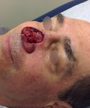 Nasal Reconstruction