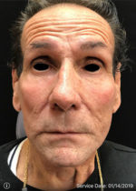 Around The Eye Fillers