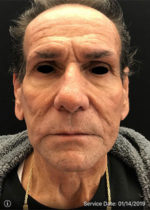 Around The Eye Fillers