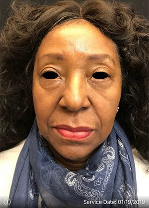 Around The Eye Fillers