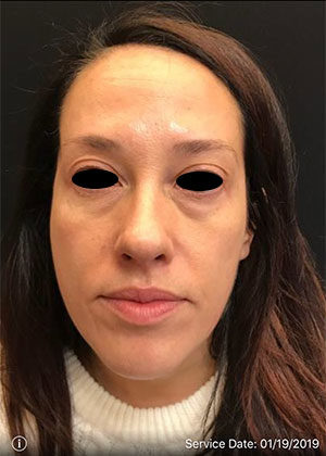 Around The Eye Fillers