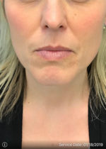 Around The Mouth Fillers