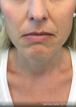 Around The Mouth Fillers