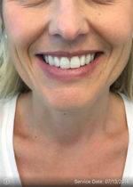 Around The Mouth Fillers