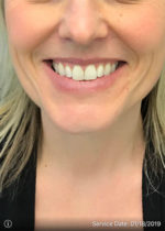 Around The Mouth Fillers