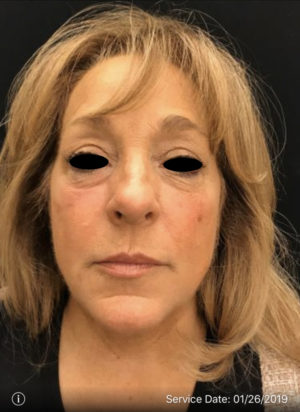 Around The Eye Fillers