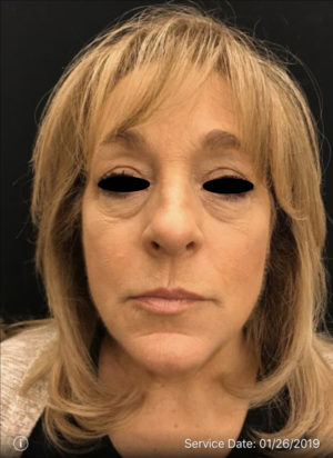 Around The Eye Fillers