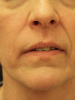 Around The Mouth Fillers