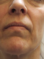 Around The Mouth Fillers