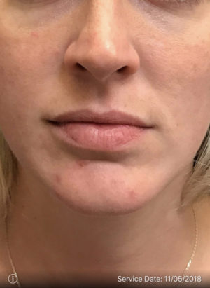Lip Augmentation