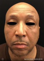 Around The Eye Fillers