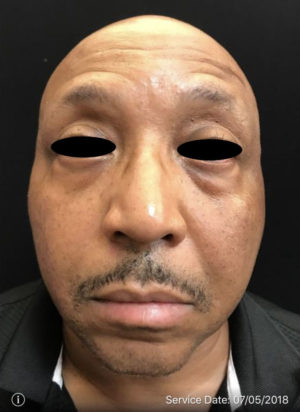 Around The Eye Fillers