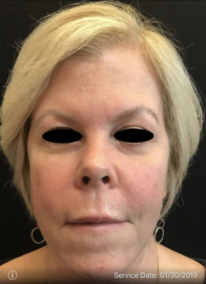 Around The Eye Fillers