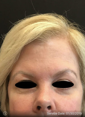 Around The Eye Fillers