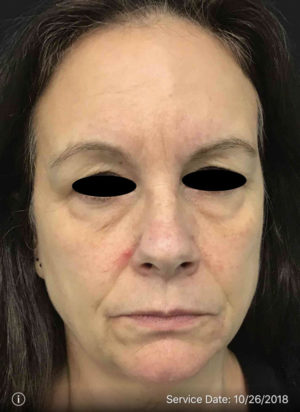 Eyelid Surgery